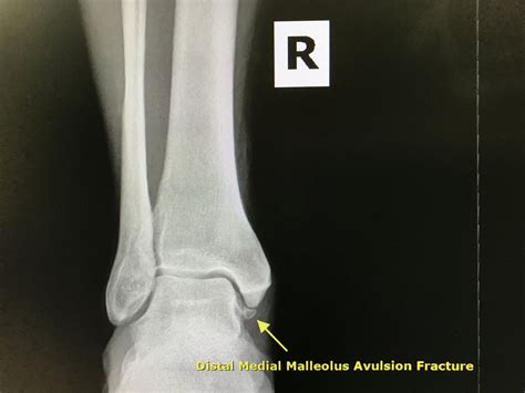 Therefore it is nearly impossible to diagnose that you have an however, the way you got the fracture and especially the details of it are very good indications of whether you have an avulsion fracture or not. Avulsion Fractures - Gilbert, AZ Foot Doctor