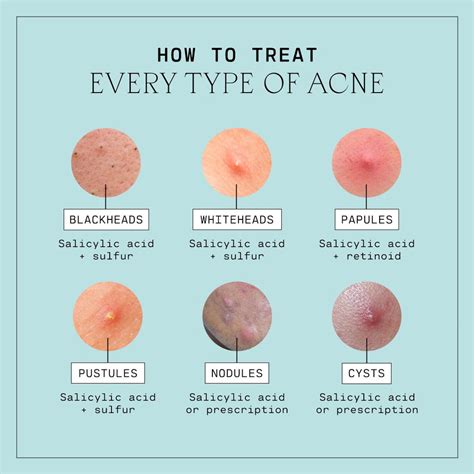 Types Of Acne Explained Versed Skin