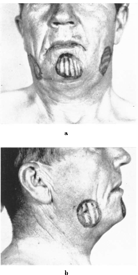 Figure 3 From A Lingual Goiter Treated With Radioactive Iodine