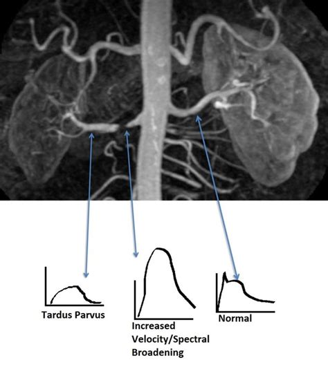 ️renal Artery Doppler Ultrasound Worksheet Free Download