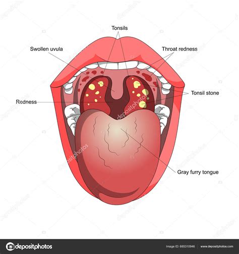 Tonsillitis Human Throat Inflammation Disease Mouth Diagram Schematic