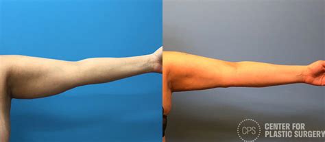 Arm Lift Before And After Photos Patient 78 Annandale
