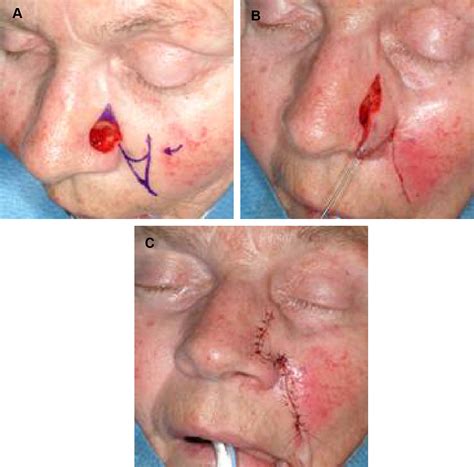 Transposition Flaps In Nasal Reconstruction Facial Plastic Surgery