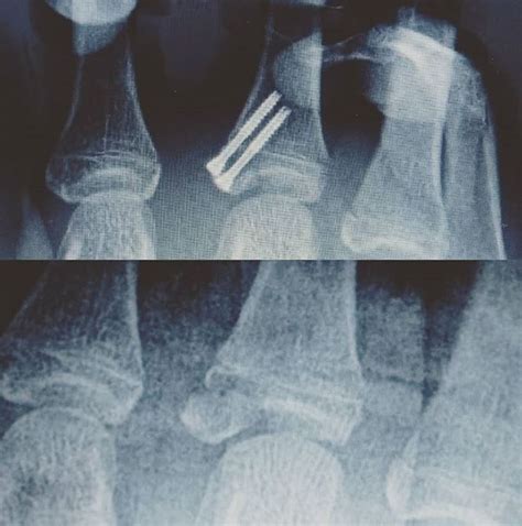 Epifisiolisis Tipo Iii De Falange Proximal De Un Dedo De La Mano En