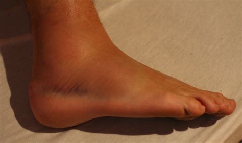Sprained Ankle Runners Guide To Diagnosis Treatment And Prevention