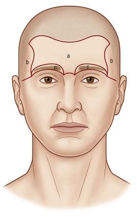 Scalp And Forehead Reconstruction Plastic Surgery Key