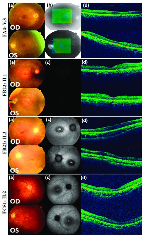 Color Fundus Photographs A Red Free Fundus Photographs B