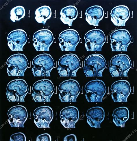 Mri Brain Scan — Stock Photo © Bunyos30 18724051