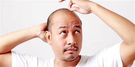 Should You Invest In A Minoxidil Shampoo If You Re Going Bald Balding Life