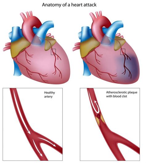 What Is An Inferior Myocardial Infarction With Pictures