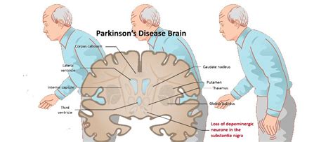 What Does Parkinsons Disease Affect Parkinsons Disease Info Club