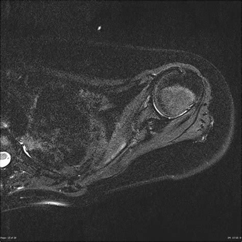 Post Radiotherapy Muscle Atrophy Image