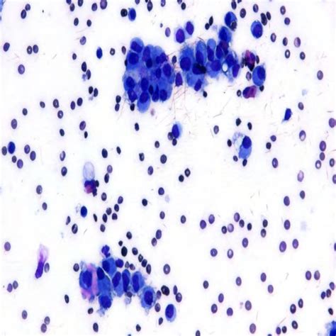 Histological And Cytological Findings Of Granulosa Cell Tumor In