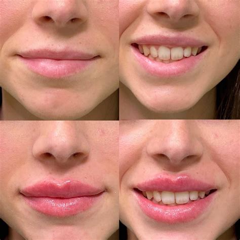aumento labios ácido hialurónico clínicas love