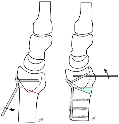 Preoperative Radiographs And Planning An Opening Wedge Osteotomy Was