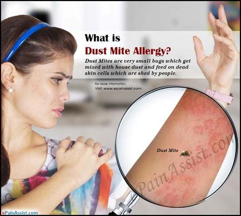 67 Amazing Symptoms Of Dust Mite Allergy In Humans Insectpedia