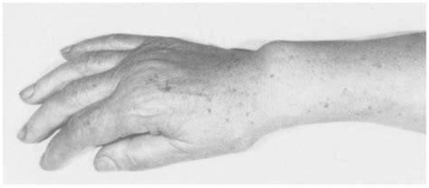 Figure 1 From Spontaneous Rupture Of Extensor Tendons In Madelungs