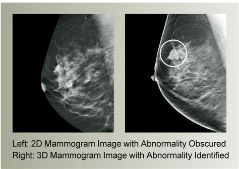 Mammogram Anatomy