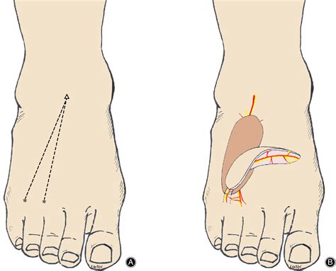 Reconstruction Of A Distal Foot Skin Defect Using An Intermediate