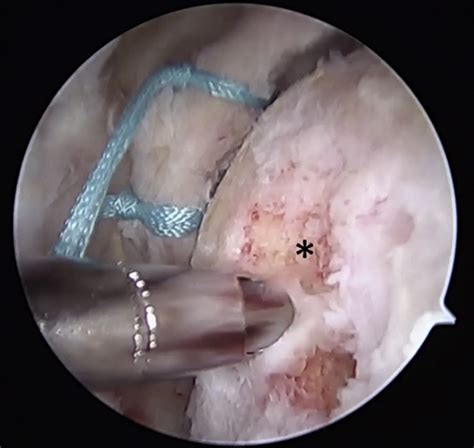 Lesser Tuberosity Avulsion Fracture Repair Using Knotless Arthroscopic Fixation Arthroscopy
