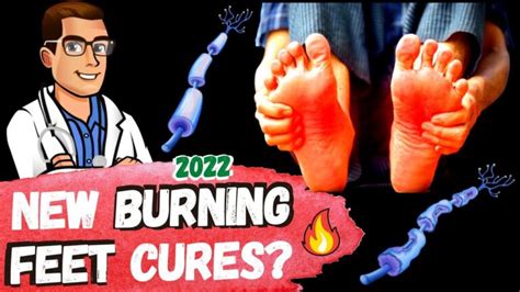 🔥top 7 Burning Feet Causes And Treatments 🔥 2 New 2022 Cures
