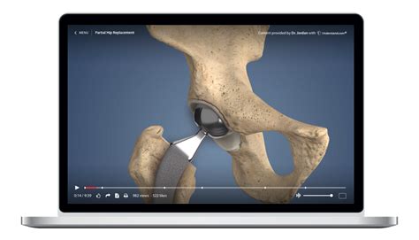 Partial Hip Replacement Animation