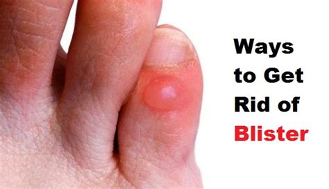 How To Get Rid Of A Blister