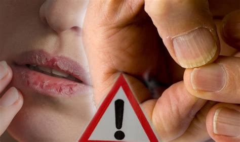 Skin Cancer Symptoms Two Lesser Known Warning Signs Found On The Lips
