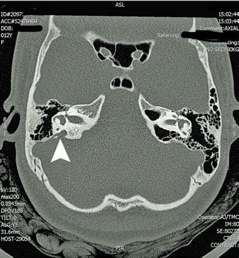 Audiovestibular Findings In Children With Enlarged Vestibular Aqueduct