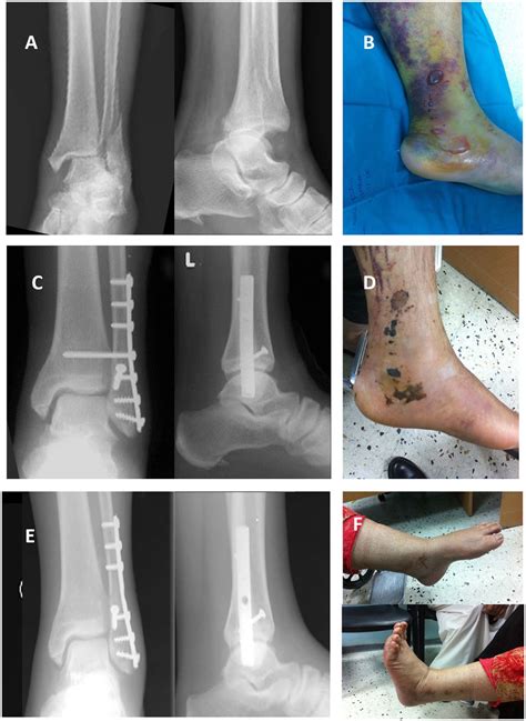Minimally Invasive Treatment Of Ankle Fractures In Patients At High
