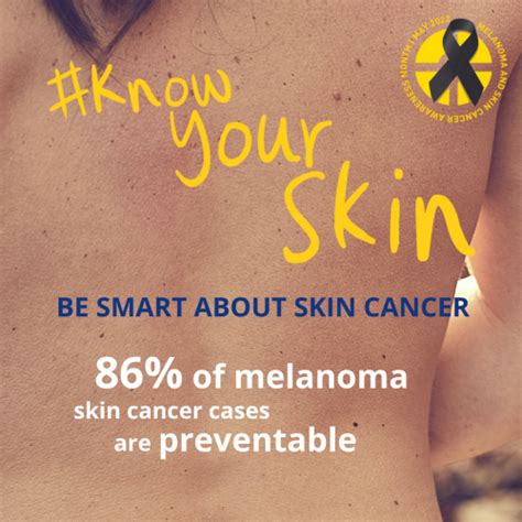 Melanoma Awareness Month Do You Knowyourskin Skemnews