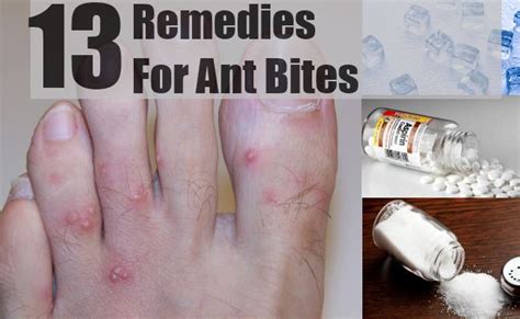 13 Home Remedies For Ant Bites Natural Treatments And Cure For Ant