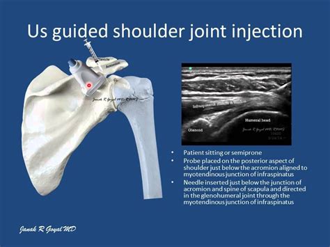 Shoulder Joint Injection Anterior Approach