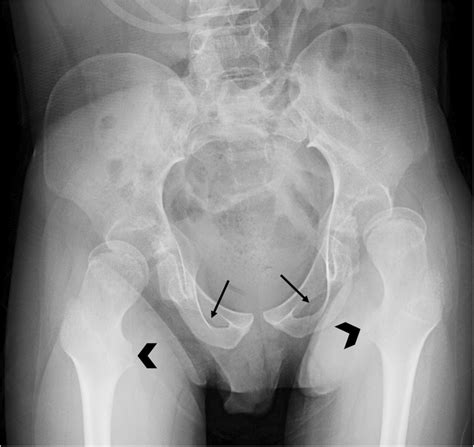 Suboptimal Positioning For An Anteroposterior Pelvis Radiograph For Hip