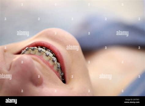 Girl Crooked Teeth Smiling Stockfotos Und Bilder Kaufen Alamy