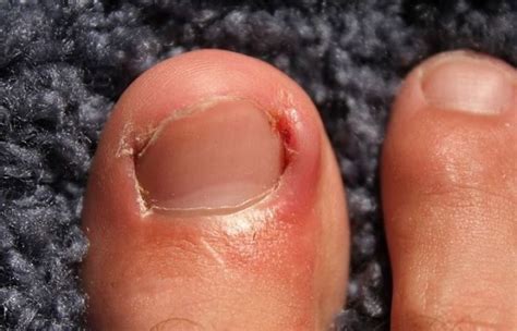 Ingrown Toenail Remedies When To See Your Doctor Such Tv