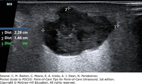 Ultrasound Assessment Of Abscess And Cellulitis Pocket Guide To Pocus