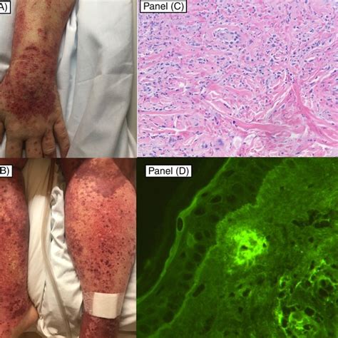 A B Bilateral Extremities With Erythematous And Violaceous