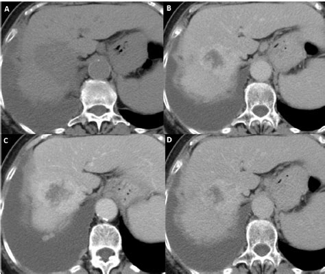Hepatic Hemangiomas Typical And Atypical Imaging Findings Pitfalls