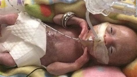 Born Before Weeks Most Premature Baby Is Now Thriving Cnn