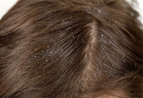 Along with otc treatments for dandruff, there are a number of natural remedies that can help. Dandruff Causes & Treatment - Weldricks Pharmacy