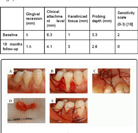 Figure 1 From Treatment Of Gingival Recession With Hypersensitivity