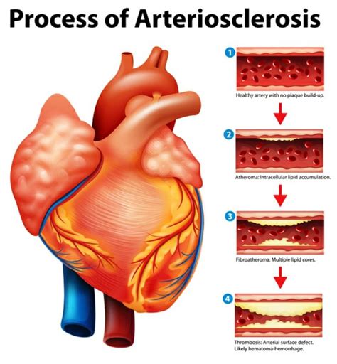 Process Of Arteriosclerosis