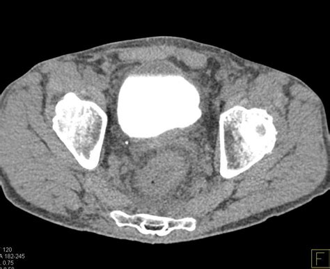 Bladder Cancer On Ct Cystogram Genitourinary Case Studies Ctisus Ct