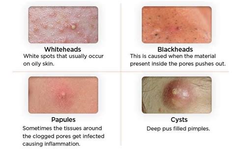 Pimples Types Prevention And Treatment Hesmi