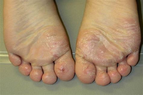 Itchy Feet 10 Common Causes What to Do Tua Saúde kienitvc ac ke