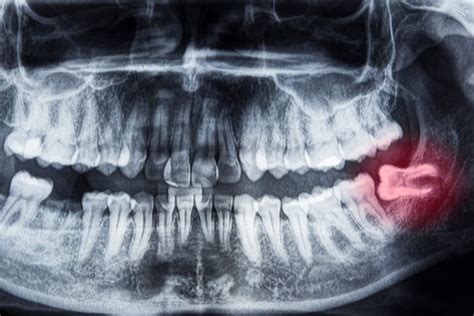 Is Wisdom Tooth Removal The Most Traumatic Dental Procedure