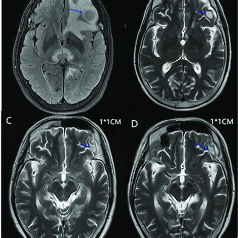 A Head Mri Of The Maximal Mass In The Left Frontal Lobe Of The Brain