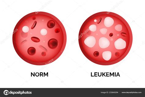 Infographic Image Leukemia Lukemia Leukaemia Isolated White Background