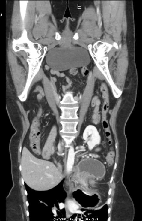 Ct Scan Chest Abdomen And Pelvis Sagittal View Showing A Large 5cm
